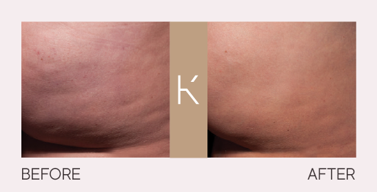 Cellulite-Celfina