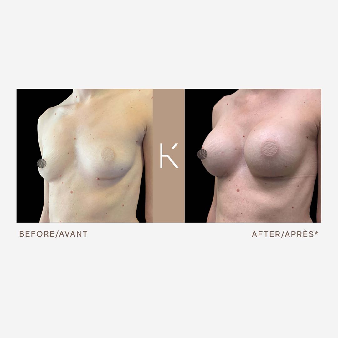 Dre Joan Sauvageau – Breast Augmentation