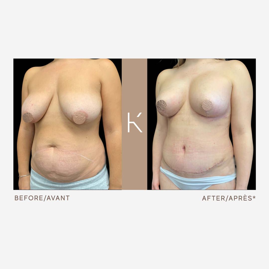 Breast Lift after Pregnancy - Gatineau, QC