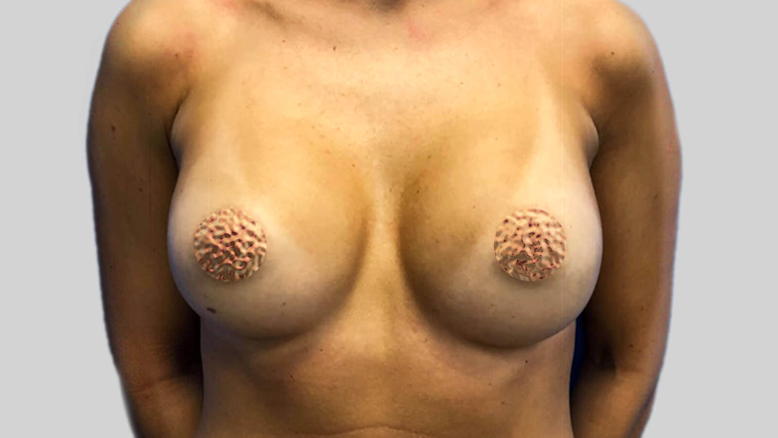 Breast-Augmentation-after (1)