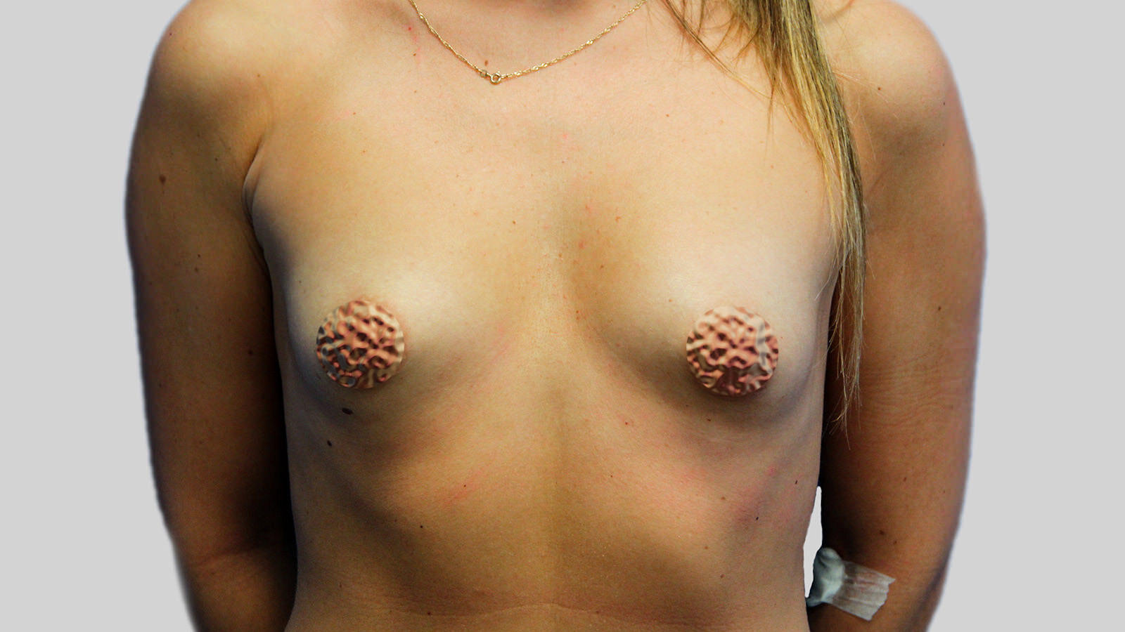 Breast-Augmentation-before (1)
