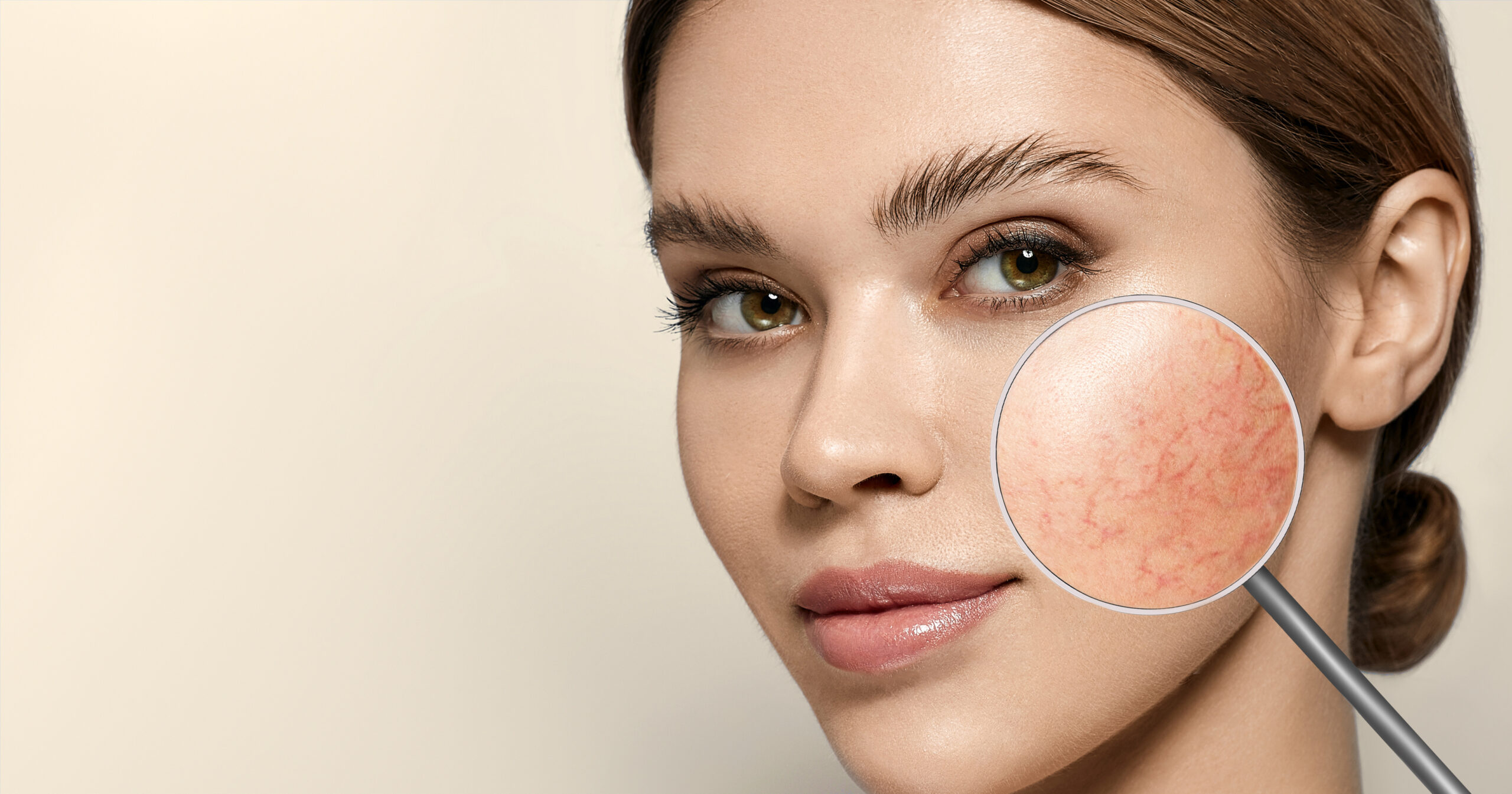 rosacea