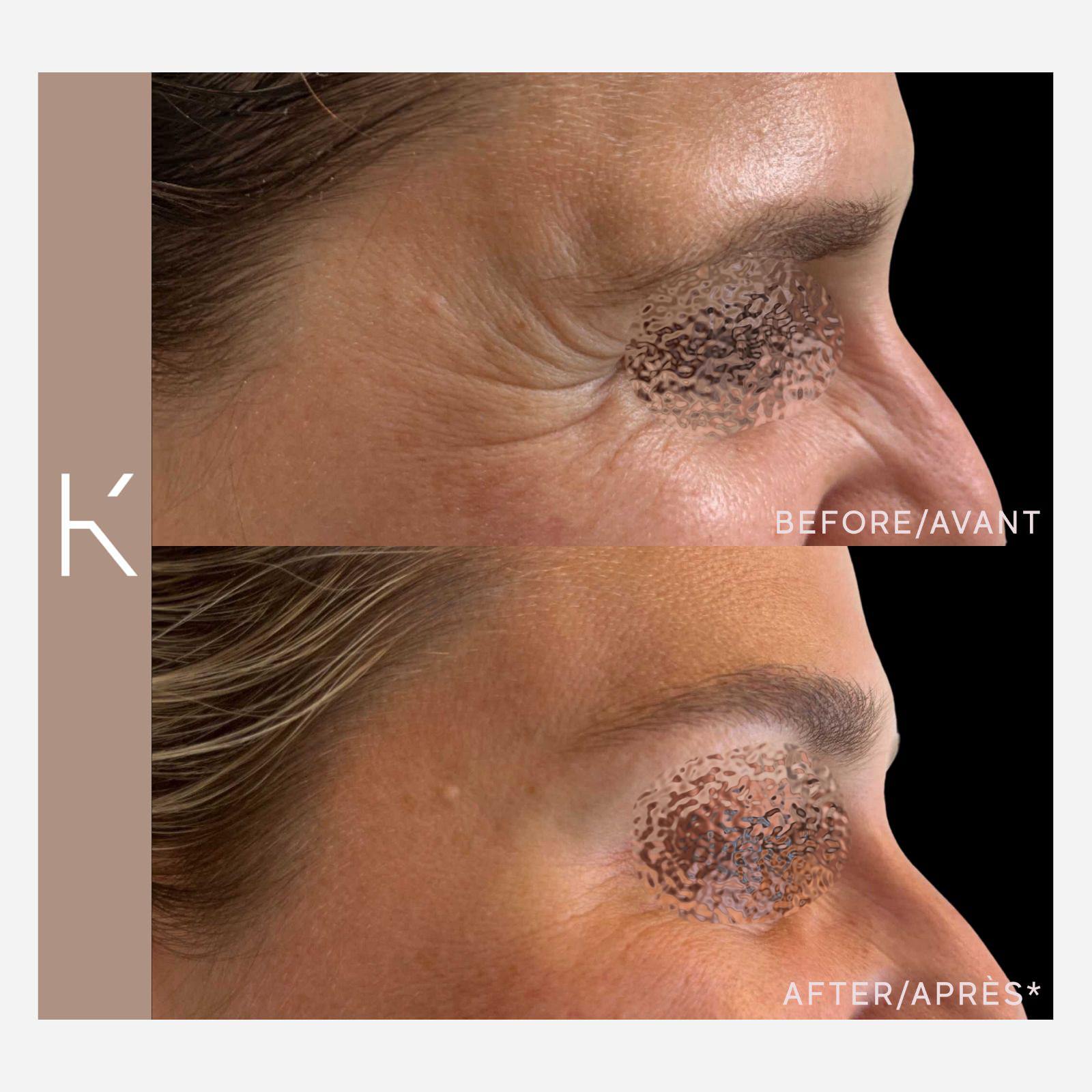 Botox Before and After: How to Refresh Your Appearance